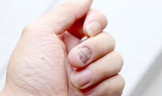 手上有竖纹是怎么回事 别紧张 或许是小问题