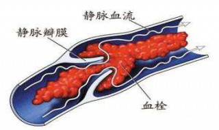 血栓能自愈吗 可以通过手术治愈