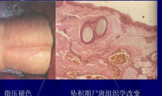 人死前多久会出现尸斑块 关于尸斑你了解多少