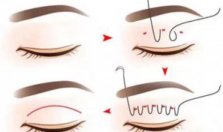 55岁能割双眼皮吗 应该注意什么