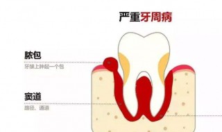 牙龈脓包能自愈吗 应该如何治疗