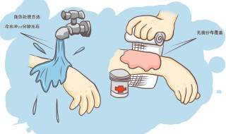 烫伤起泡怎么办 急求方法有哪些