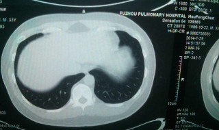 毛玻璃结节和磨玻璃结节的区别 毛玻璃结节和磨玻璃结节怎么区分