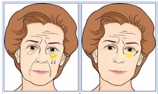 简单有效去眼袋方法 要认真按摩眼部