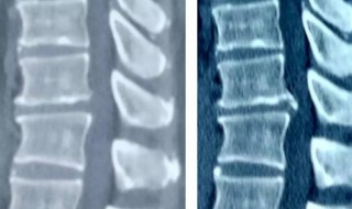 腰椎膨隆是什么意思 腰椎膨隆意思