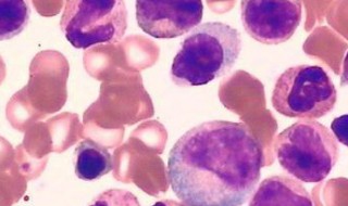 血液病是大病吗 血液病重大疾病详解