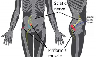 梨状肌能自愈吗 还是治疗比较好