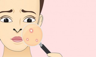 消痘痘最快的方法 消痘痘的方法