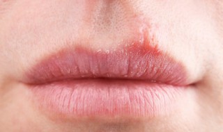 为什么容易上火 怎么才能避免上火