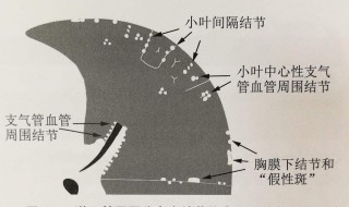 气管里结节是什么 是什么疾病