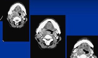 颈部肿块和肿瘤的区别 颈部肿块和肿瘤的区别是什么