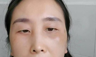 眼袋重怎样消除 眼袋重消除方法