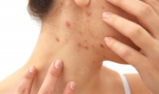 使用粉刺针的注意事项 使用粉刺针要注意什么