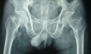 腰部骨折能自愈吗 应该注意什么