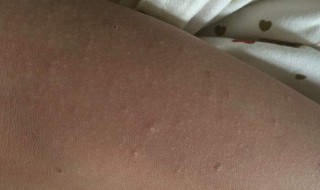 后背发黑痒是怎么回事 后背一直发黑,粗糙还痒,是怎么回事