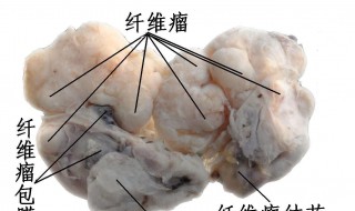 乳腺纤维瘤危害大吗 乳腺纤维瘤要紧吗