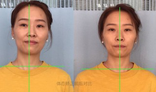 颈椎侧弯怎么矫正 颈椎侧弯矫正方法