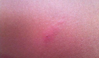 皮肤有螨虫怎么办 发现皮肤有螨虫怎么解决