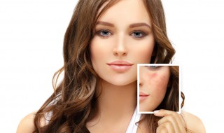 怎么消除痘痘印 这三种方法最为健康