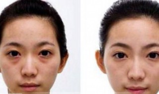 怎么样除眼袋 怎样能除眼袋