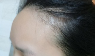 女生额头高怎么办 女生额头高解决方法