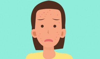 怎么去除痘痘 去除痘痘的方法