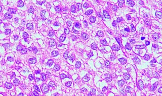 免疫组织化学染色诊断是什么意思 免疫组织化学染色诊断的含义