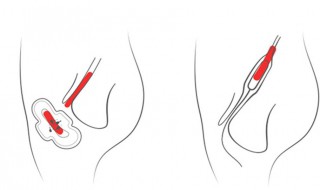 卫生棉条推一半顶住了怎么回事 卫生棉条推一半顶住了解决方法