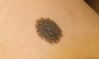 什么是朱砂痣 朱砂痣简单介绍