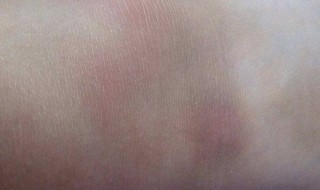 身上的淤青怎样快速消除 身上的淤青快速消除的方法