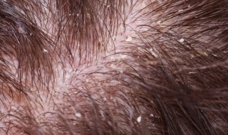 头上有头皮屑在家怎么解决 头上有头皮屑在家怎么办