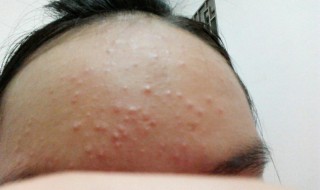 长青春痘要怎么解决 长青春痘的处理方法