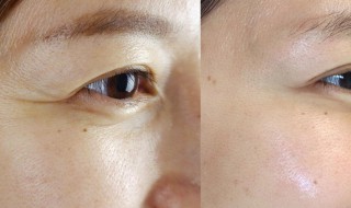 鱼尾纹除皱方法小窍门 鱼尾纹除皱方法小窍门视频