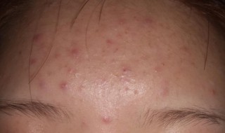 为什么刷酸会爆痘 刷酸会爆痘是什么原因呢