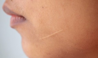 夏天有什么遮疤小技巧吗 夏天有什么遮疤小技巧吗图片