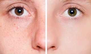 最简单有效的祛斑方法 简单有效的祛斑方法