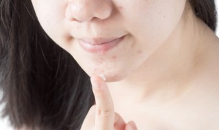 天然祛痘方法 天然祛痘方法分享