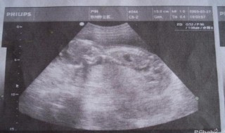 什么叫棱形胎盘 胎盘呈什么形状