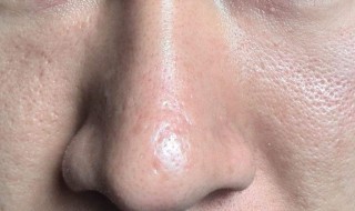 皮肤毛孔突出是怎么回事 皮肤毛孔突出是怎么回事啊