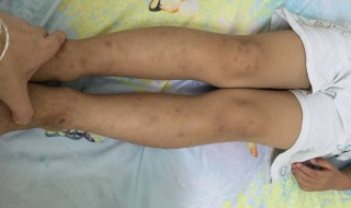 如何矫正x型腿幼儿 幼儿轻微x型腿怎么矫正