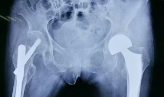 人工骨是什么材料（人工骨是啥）