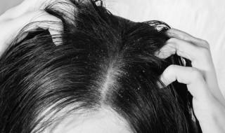 头屑多简单去除方法(头屑多简单去除方法用什么)