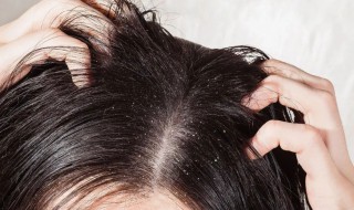 怎样洗头去头皮屑（怎样洗头去头皮屑又快）