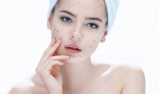 痘印痘坑怎么修复最好(痘坑修复最有效的方法)