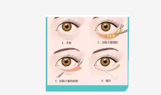 下眼袋大怎样去除 下眼袋大怎样去除泪沟