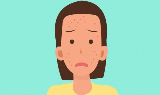 鼻梁长痘痘原因 鼻梁长痘痘原因图片