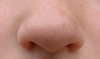 粉刺最好的消除方法（怎样可以消除粉刺）