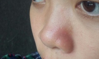 冬天鼻子红怎么解决 冬天鼻子红怎么解决图片