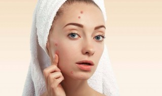 痘痘小妙招（怎么快速去痘痘小妙招）