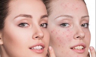 额头长痘应该如何护理 额头长痘应该如何护理呢